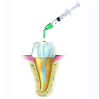 Sistema de irrigación endodoncia de presión negativa dental
